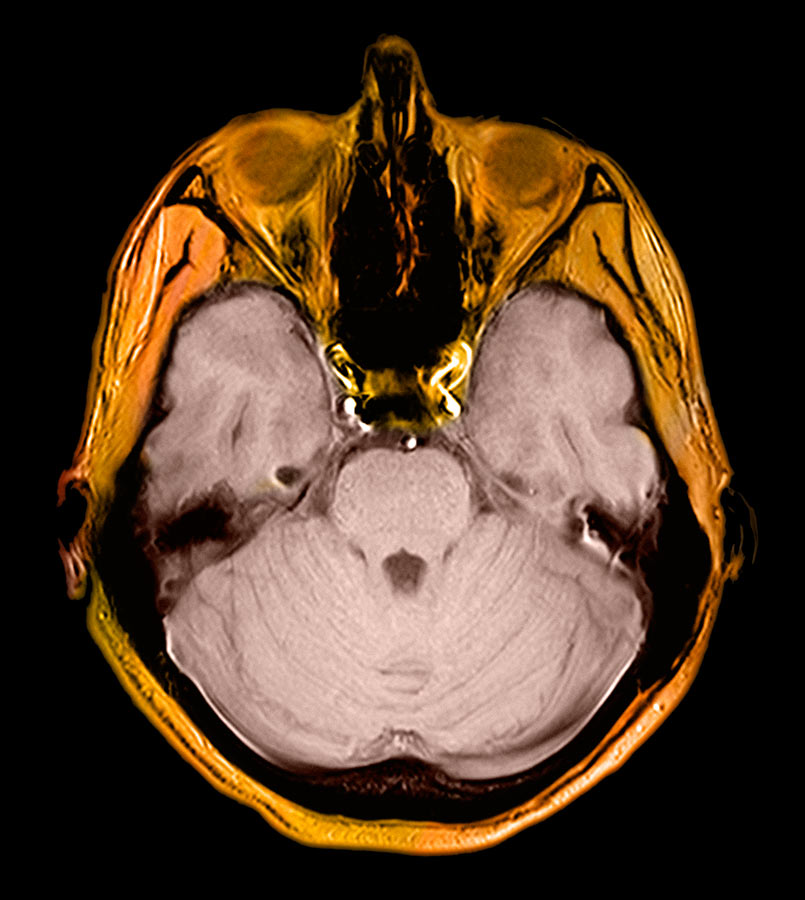 Colorized MRI image of a brain.