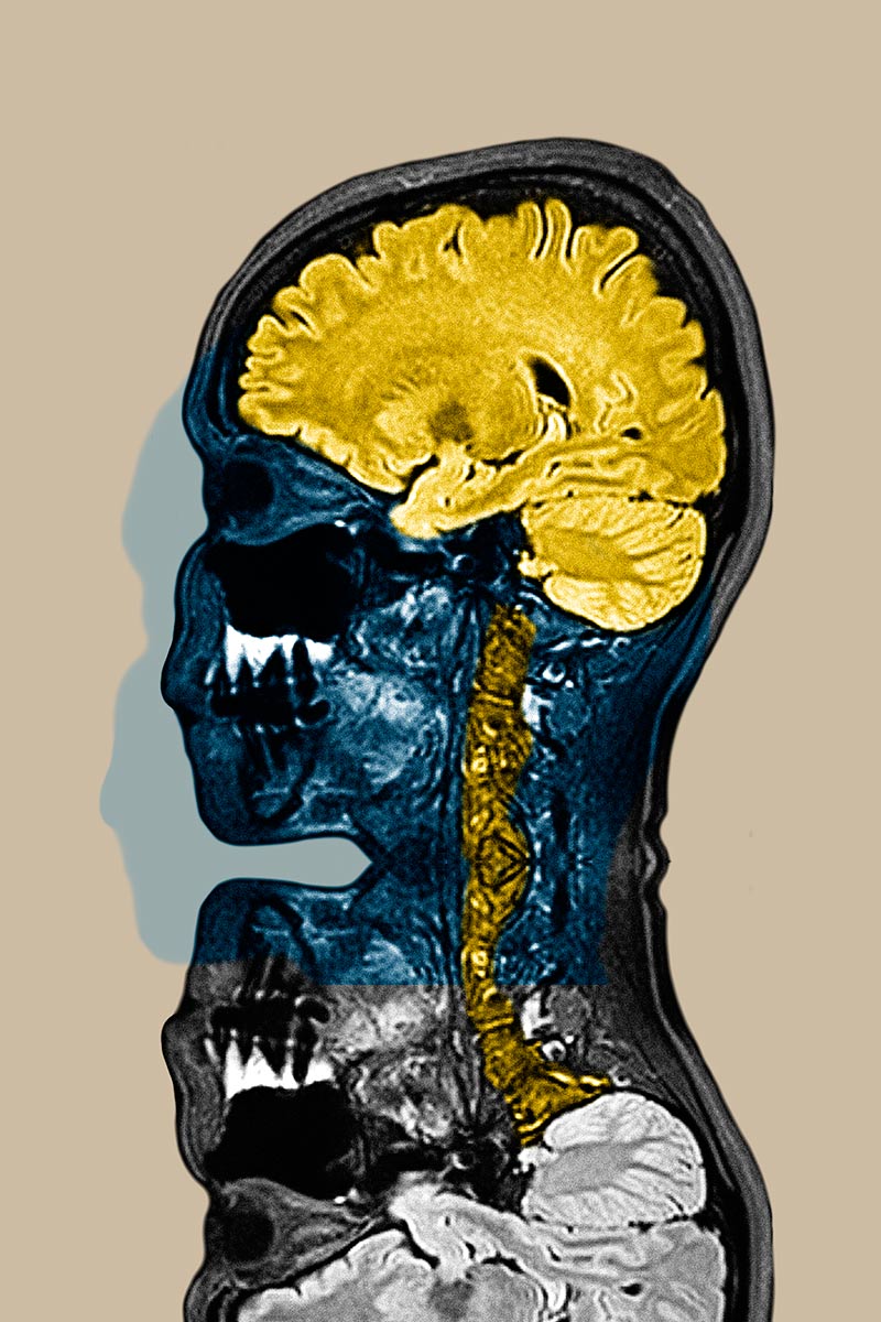 Colorized and mirrored MRI image of the head and brain in a sagittal plane.